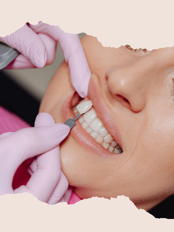 Veneers and Crowns