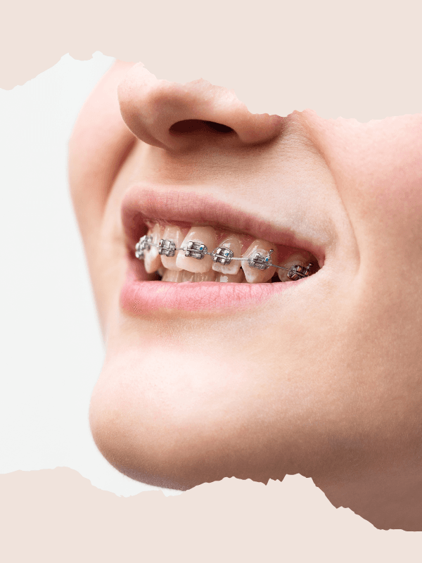 Fixed Orthodontics