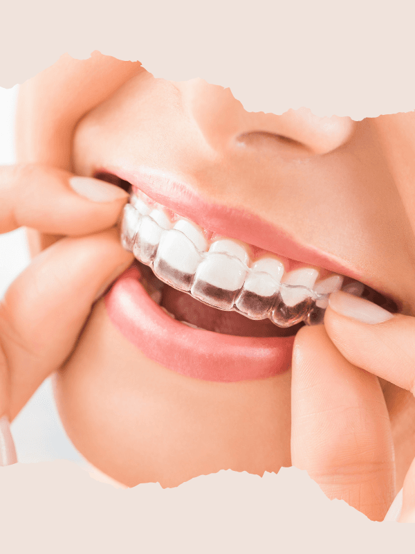 Clear Aligners