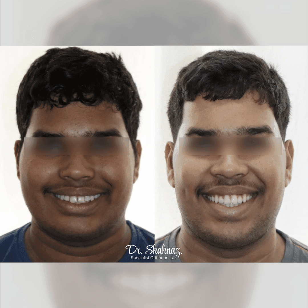 Aligner Treatment